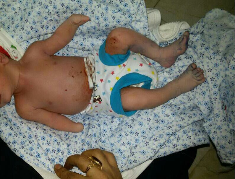 تولد نوزادی در دهدشت که دو دست ناقص دارد + تصویر