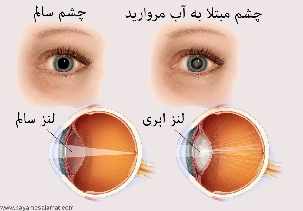 بیماری چشمی به نام آب مروارید/ از آب مروارید چه می دانید؟ / آیا آب مروارید در کودکان هم مشاهده می شود؟