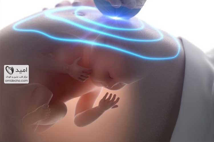 اکو قلب جنین راه اصلی تشخیص بیماری قلبی جنین در دوران بارداری