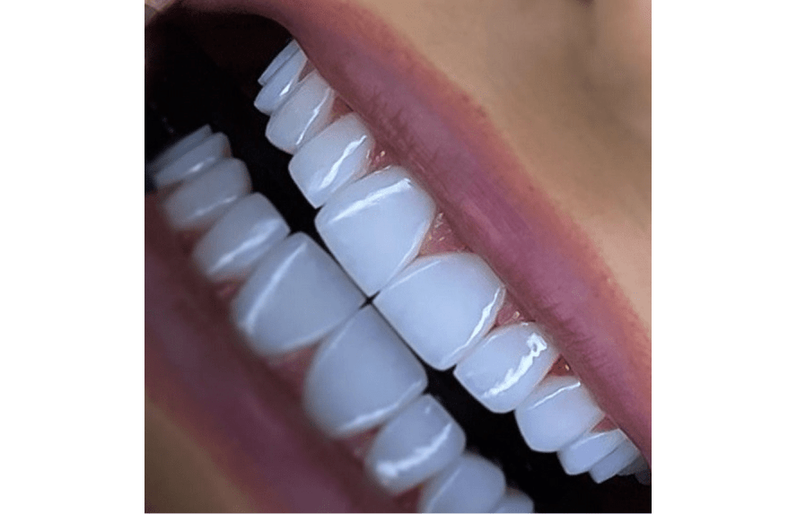 همه چیز در مورد کامپوزیت دندان